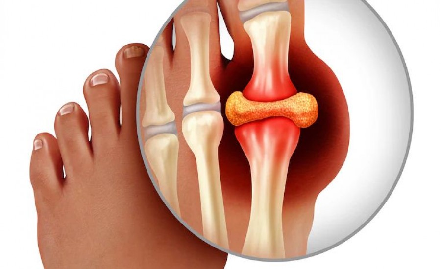 यूरिक एसिड